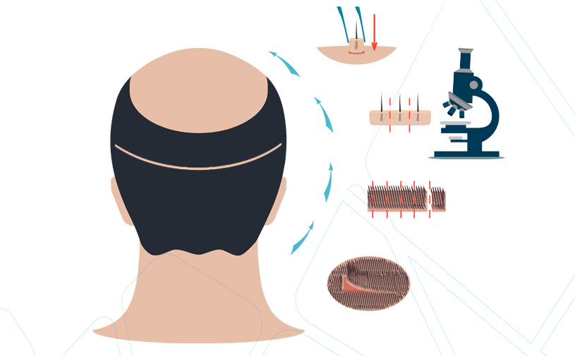 Imagem Transplante Capilar FUT